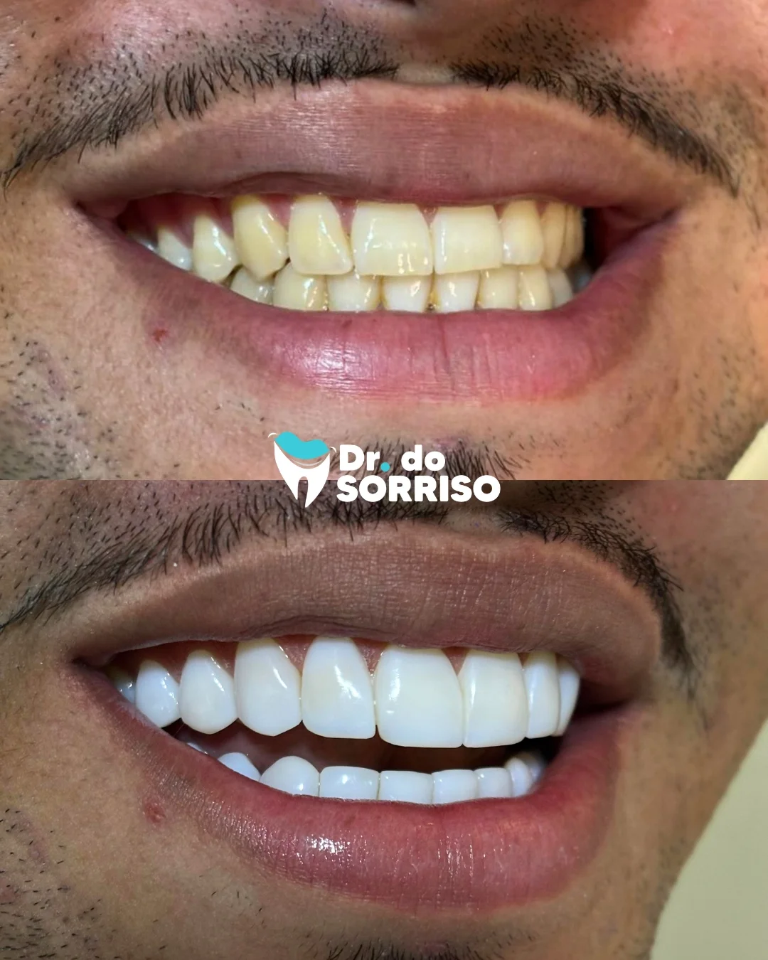 Antes e depois de facetas dentais