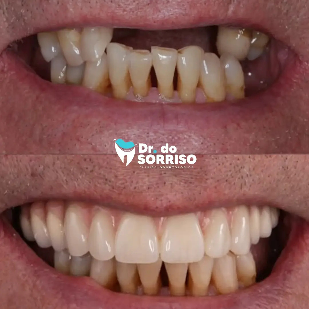 Clareamento Dental