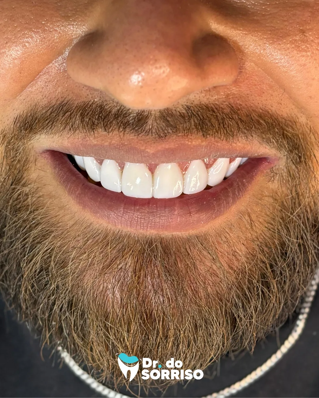 Resultado de tratamento estético dental