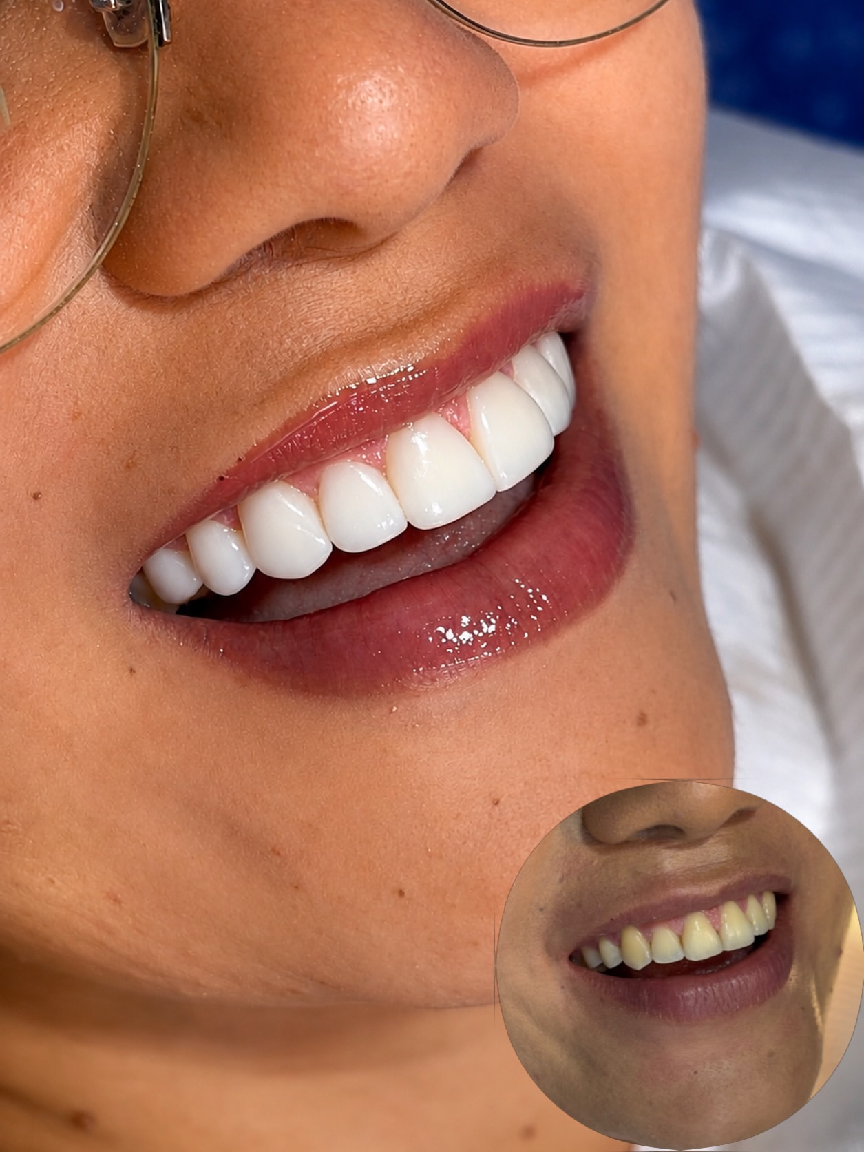 Facetas em Resina