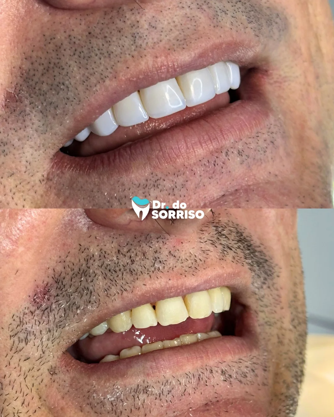 Harmonização Facial