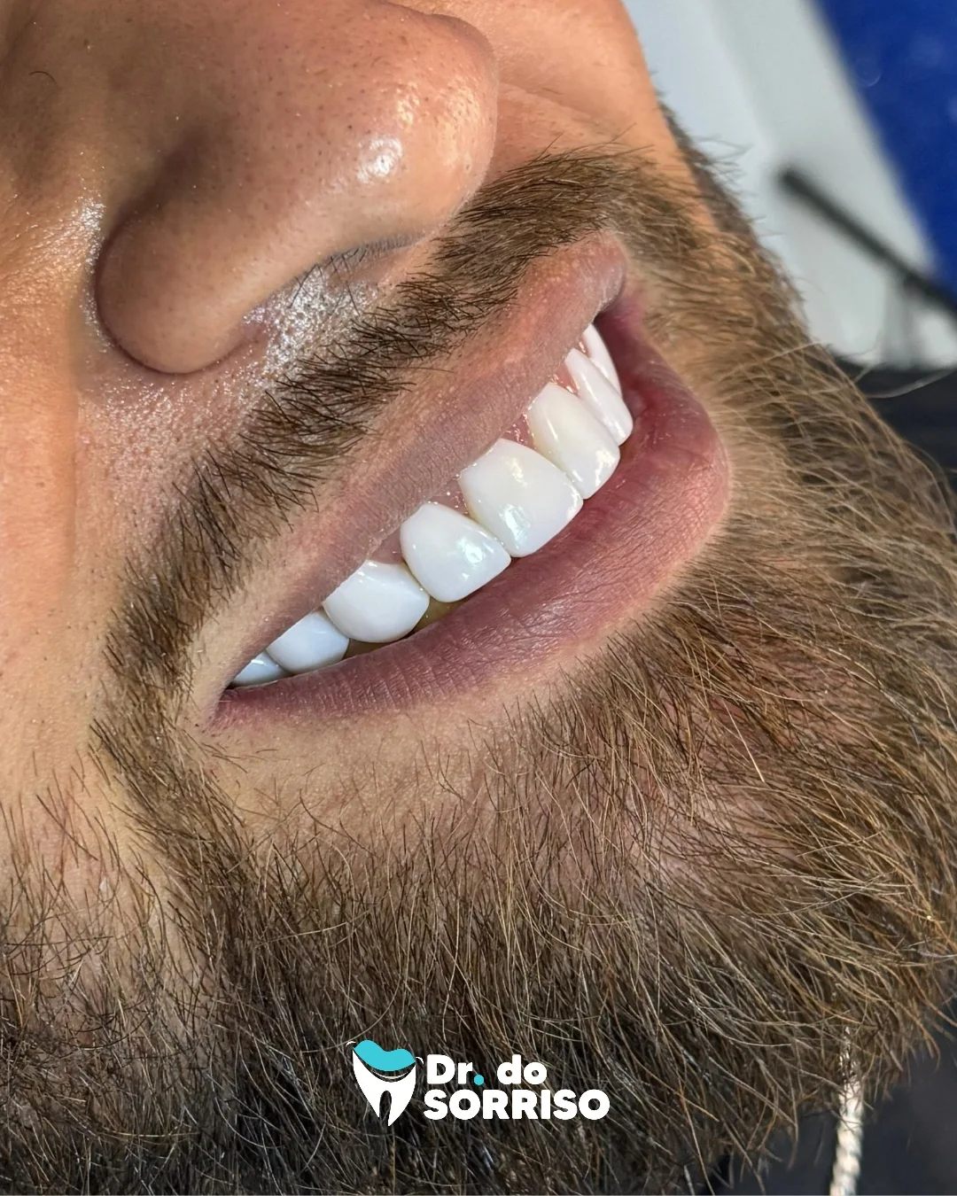 Resultado de tratamento com facetas