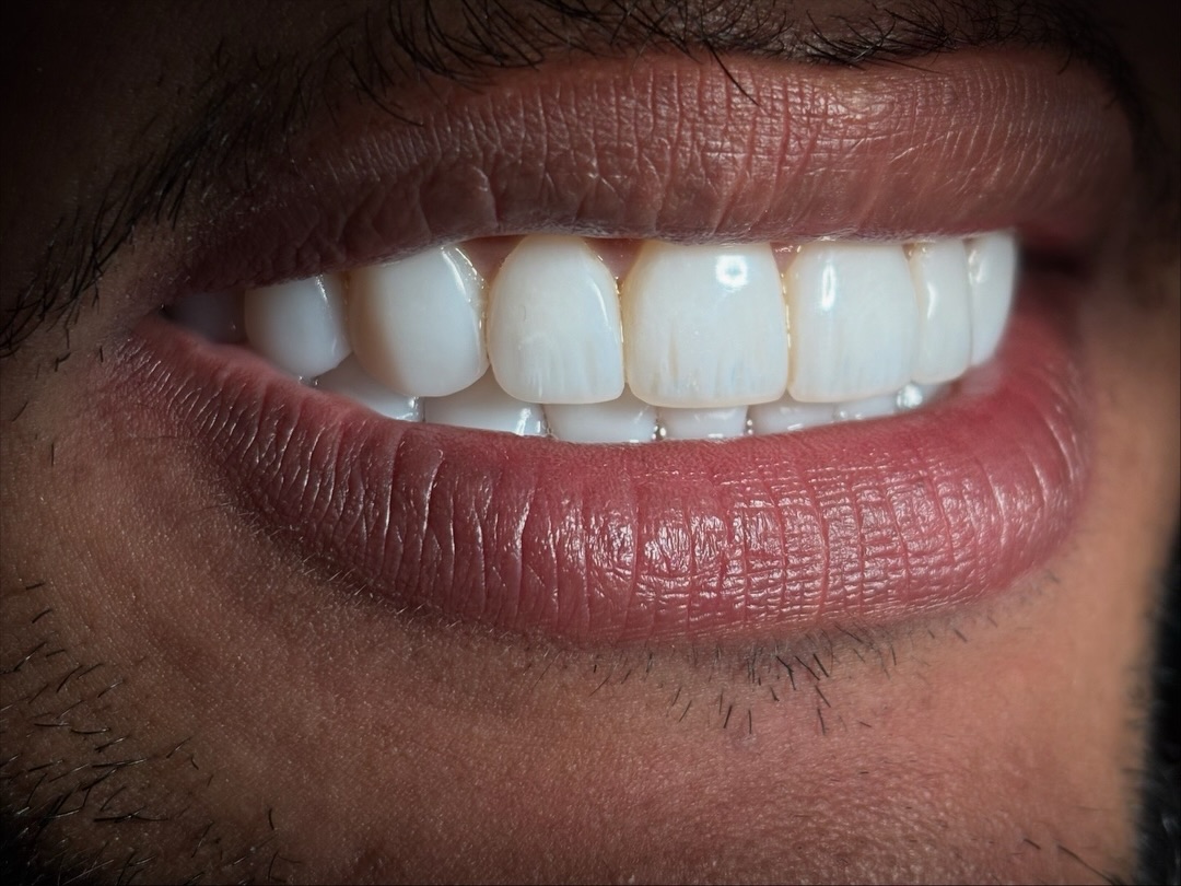 Sorriso com facetas de porcelana em detalhe
