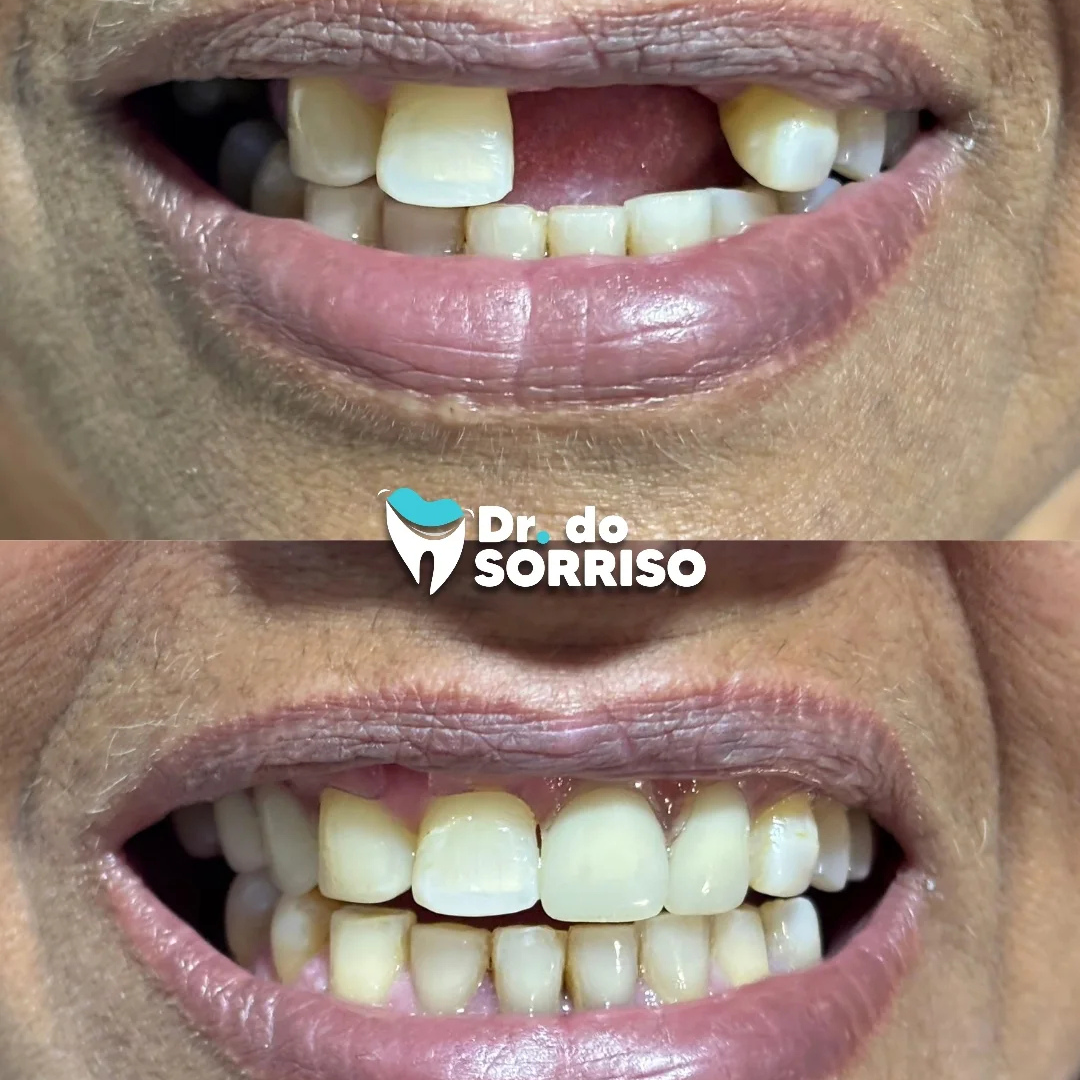 Implante Dentário