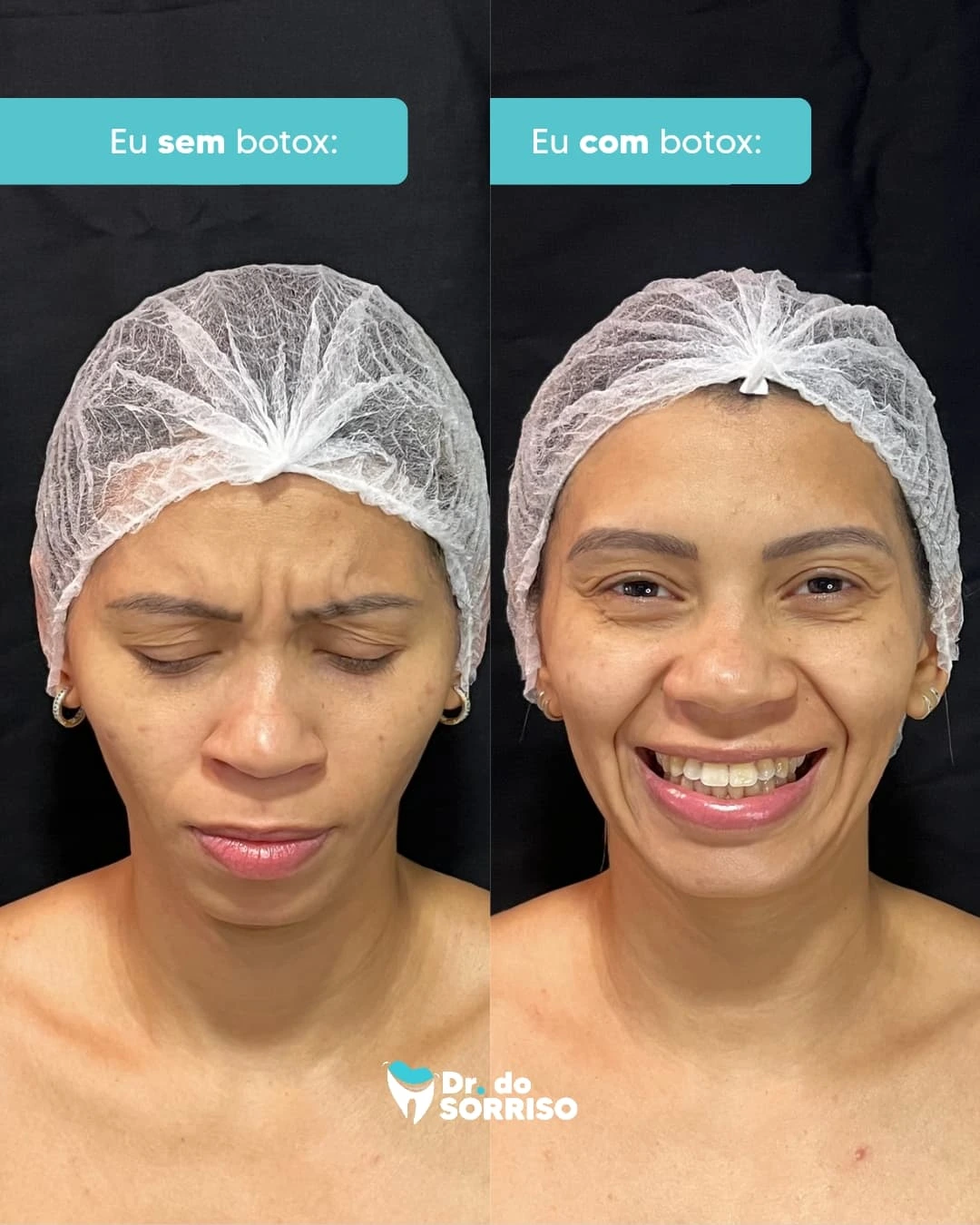 Botox Terapêutico